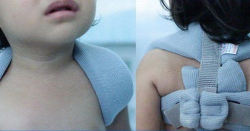 Gãy xương là một trong những chấn thương ở trẻ em