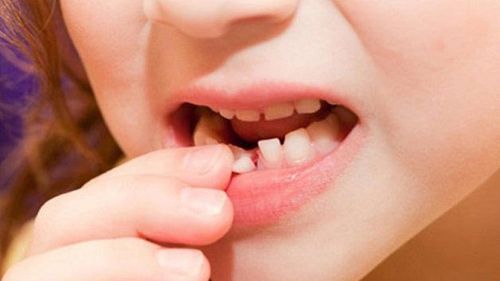 Một trong các chấn thương thường gặp ở trẻ là gãy, sứt, mẻ răng