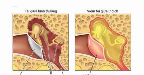 
Hình ảnh mô tả tình trạng viêm tai giữa ứ dịch
