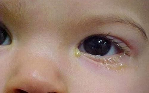 Trẻ sơ sinh hay đổ ghèn mắt có sao không?
