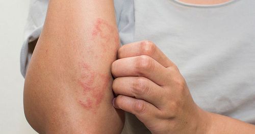 Top eczema triggers to avoid