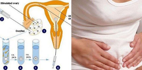 Bụng căng, đau khi thở mạnh sau chọc hút trứng là sao?