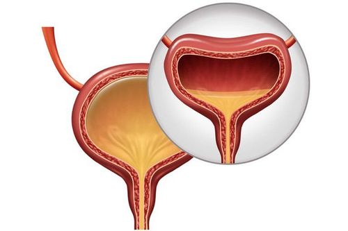 Có điều trị dứt điểm bàng quang tăng hoạt được không?