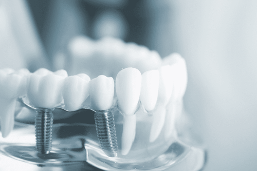 Răng sau khi cấy ghép Implant và bắc cầu sứ có bị tiêu xương không?