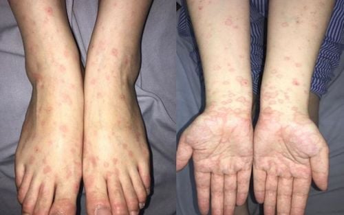 
Phòng ngừa herpes sinh dục bùng phát là rất quan trọng
