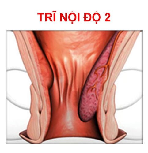 How to treat internal hemorrhoids more than 2 degrees?