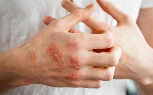 
Mụn nước chàm da eczema là một trong các loại mụn nước thường gặp
