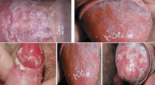 Some images of penile yeast infection in male