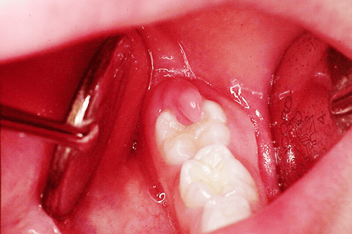 Đau răng do viêm lợi trùm có nên nhổ răng không?