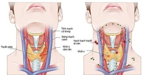 
Hình ảnh ung thư vòm họng giai đoạn 4
