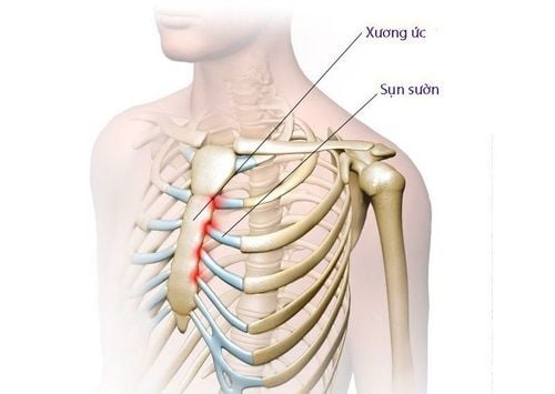 Nữ giới đau xương ức điều trị như thế nào?