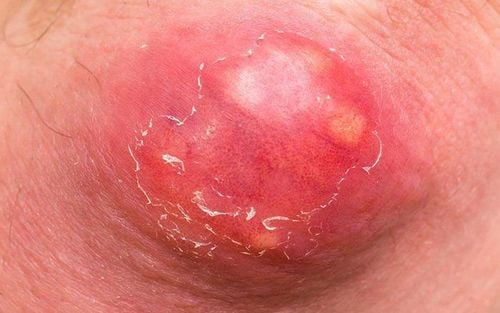 Infected boils need to be detected and treated carefully