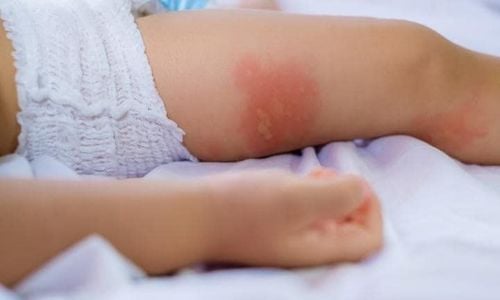 
Một số vết muỗi đốt có thể lây truyền virus và gây ra các bệnh nghiêm trọng
