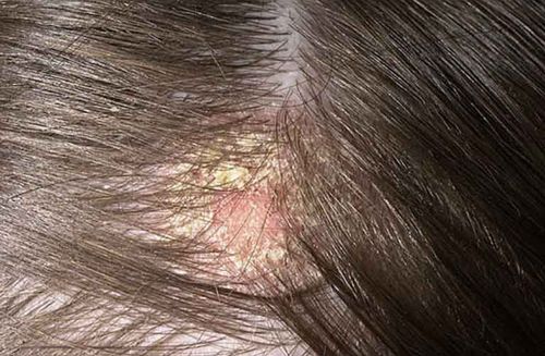 Scalp and neck cancer