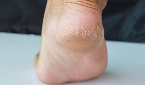 Cracked heel is lacking in what substance?