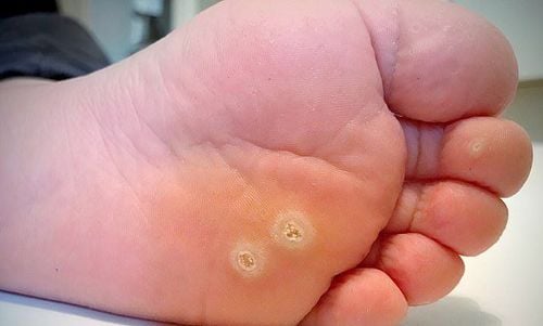 Mụn cóc ở lòng bàn chân là một trong các bệnh về lòng bàn chân thường gặp