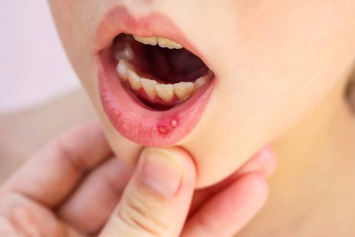 How quickly can children with mouth sores heal?