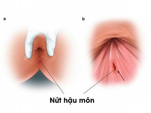 Nứt hậu môn điều trị thế nào?