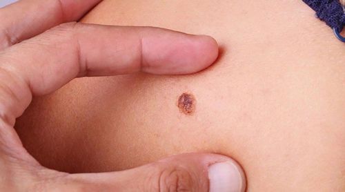 Precancerous skin lesions and skin cancer