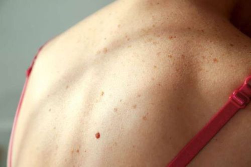 Những vị trí không ngờ trên cơ thể có thể mắc ung thư da