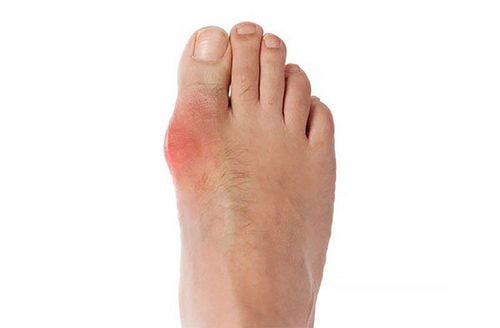 Các triệu chứng bị gout có dễ nhận diện?