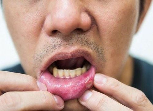 
Lở miệng HIV có thể do virus HPV gây ra
