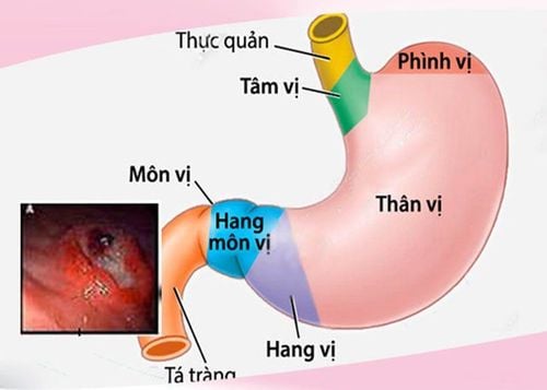 What is the reason for the treatment of gastritis that does not go away?