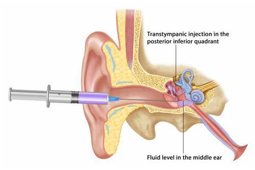 
Bị choáng váng mất thăng bằng có thể do ứ nước mê nhĩ gây ra
