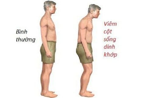 Phương pháp nào chẩn đoán viêm cột sống dính khớp chính xác?