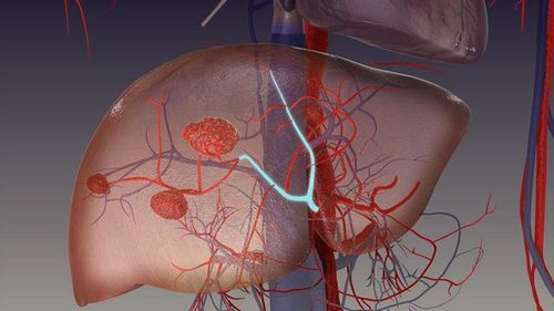 Is hepatomegaly with segment VI of 14mm in size?