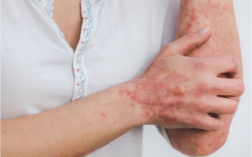 9 ways to reduce stress when you have psoriasis