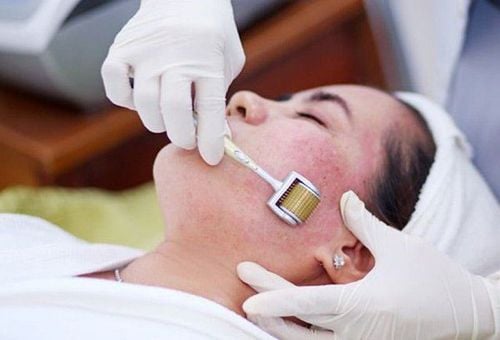 
Điều trị da nhiễm corticoid bằng công nghệ lăn kim và lột da
