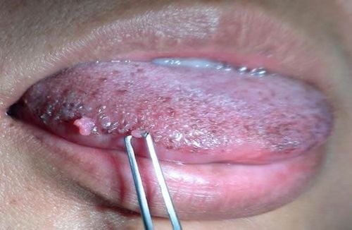 Oral genital warts are caused by the HPV virus.