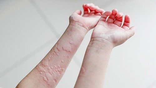 What to do with urticaria to relieve itching?