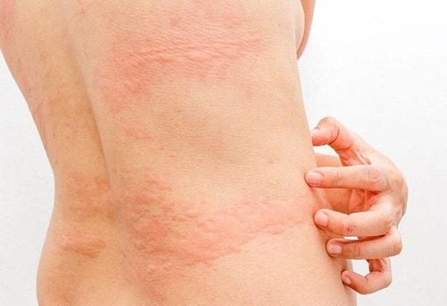 Clarityne is used to treat urticaria and allergies