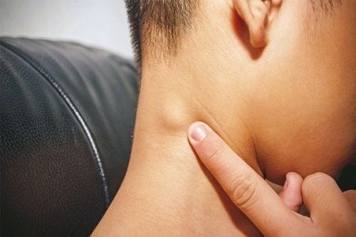 
Hạch sau gáy có thể đang cảnh báo một bệnh lý nào đó
