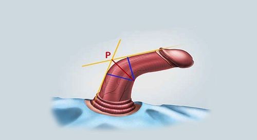 Curved penis affects "sex"?