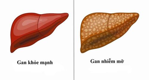 Signs of non-alcoholic fatty liver