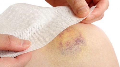 Treatment of yellow bruises on the skin