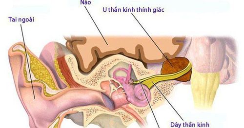 
U dây thần kinh thính giác có thể khiến người bệnh bị ù lỗ tai
