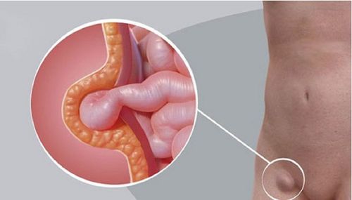 Treatment of inguinal hernia