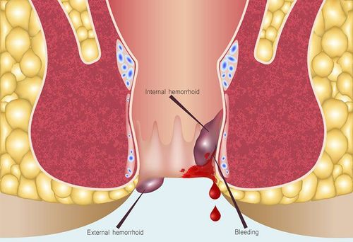 What is the painless treatment for internal hemorrhoids?