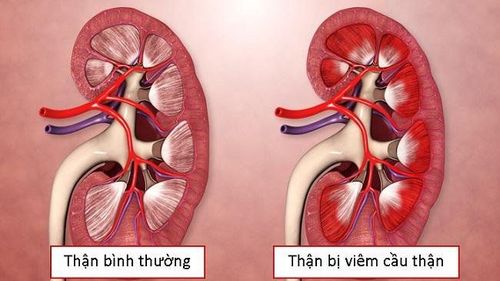 
Viêm cầu thận là một trong các biến chứng của viêm gan B mạn tính
