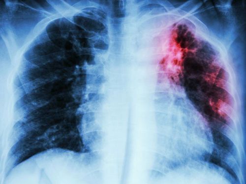 Common pulmonary tuberculosis complications