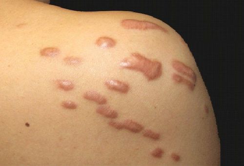 What to do when the scar is swollen?