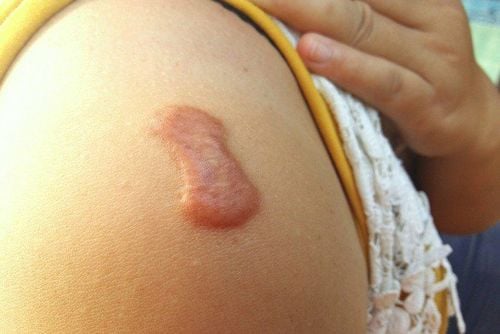 A swollen and painful scar is one of the symptoms that can occur with a keloid. In addition, keloids can also cause itching, which is very uncomfortable, and the scar tissue tends to expand beyond the original wound size. At this point, the keloid can affect your daily life, such as physical movement, friction with clothing causing pain, and loss of aesthetic appearance.
Although a swollen and painful scar is not harmful, it is important to understand the cause of this condition to know how to treat it and prevent it from affecting your quality of life.
A scar is a protective mechanism of the body that helps heal damaged skin tissue. However, in some cases, once the tissue healing process finishes and the skin heals and flattens, instead of signaling the body to stop, the process continues, causing the scar to grow excessively, leading to keloids or hypertrophic scars.
Pain and itching are not symptoms that appear in most cases of keloid or hypertrophic scars. Only some people experience pain or itching, especially those with a tendency to form scars or those with darker skin.
The cause of this condition is that during the tissue healing process, the body releases mediators that break down histamine sacs and cause itching. Changes in weather or friction or contact with the scar can also stimulate the scar to swell, turn red, and itch.
Additionally, a swollen and painful scar can also be caused by the scar tissue growth process, which increases blood vessel production to deliver oxygen and nutrients to the damaged skin area, helping to regenerate and produce more tissue.