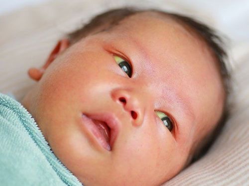 Why babies have yellow eyes