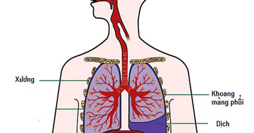 Complications of lymph node tuberculosis