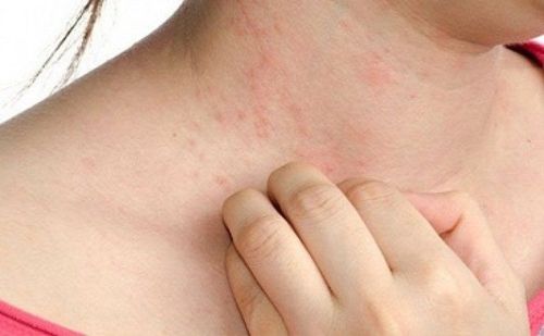 Common summer skin diseases