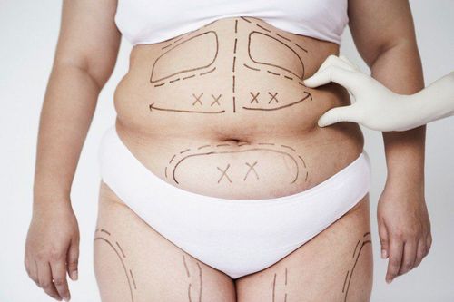 Weight loss surgery: What you need to know